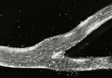 Cerebral carotid flow