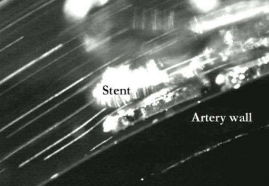 Pulsatile flow stent artery wall