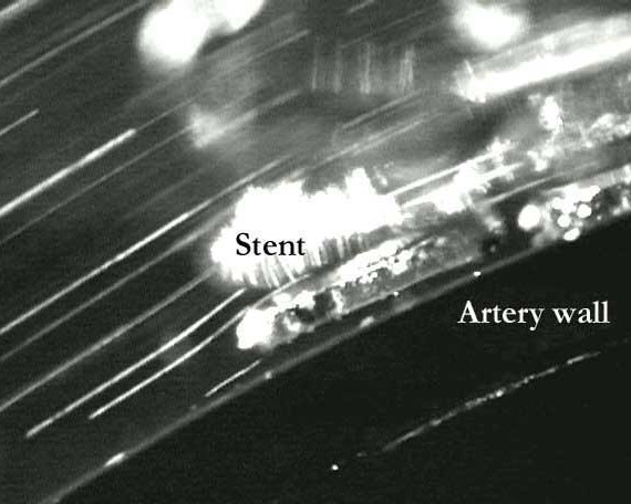 Pulsatile flow stent artery wall