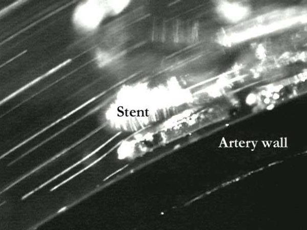 Pulsatile flow stent artery wall