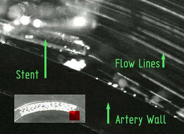 Pulsatile flow stent exit